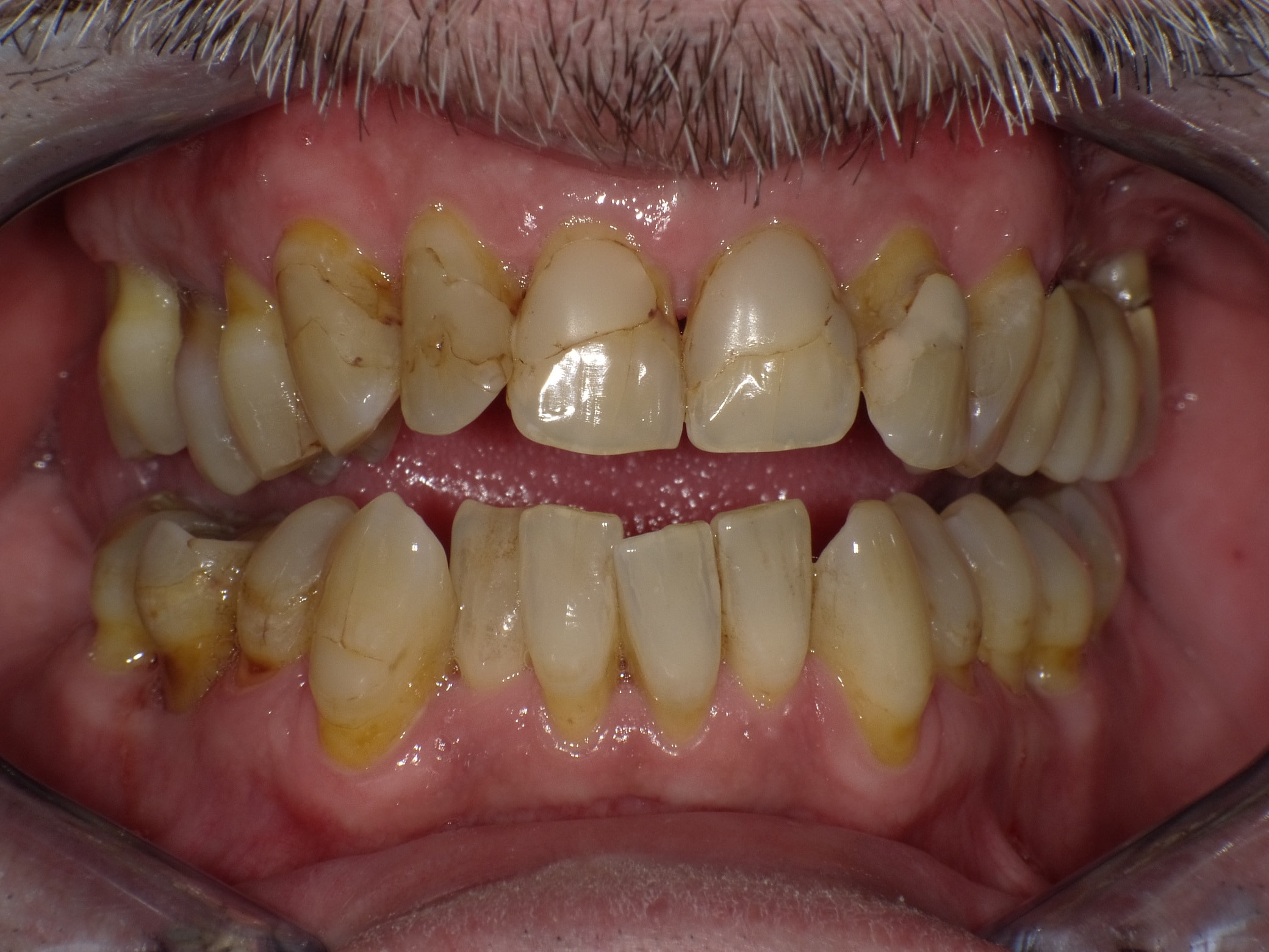 Unbefriedigende Ästhetik, vor allem aber Entzündungen im Knochen und eine massive Parodontitis mit bereits gelockerten Zähnen