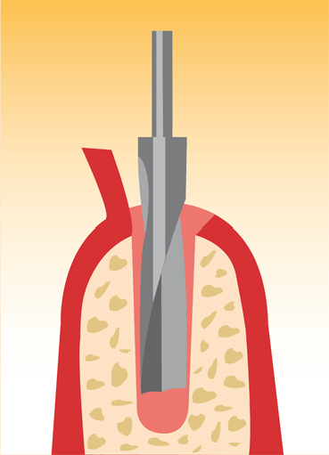 Ablauf einer Implantation 1