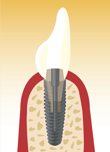 Ablauf einer Implantation 3