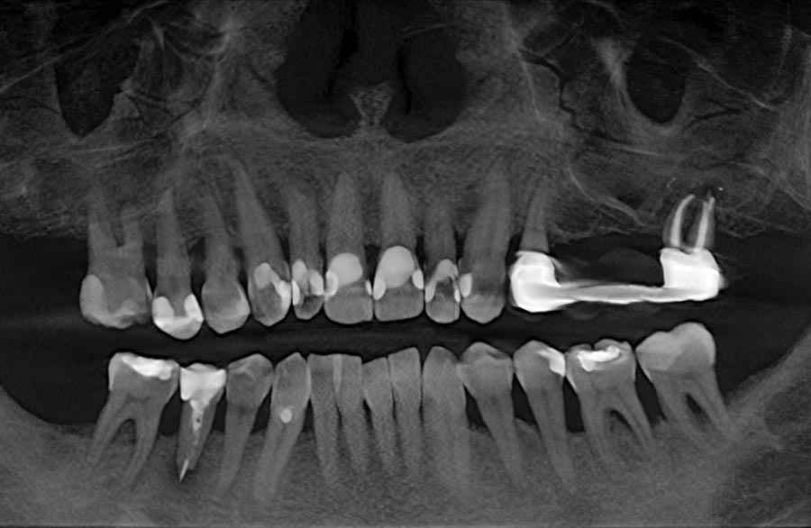 der obige Fall röntgenologisch vorher