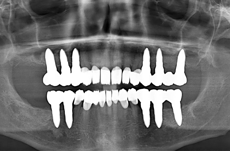 man kann die Keramik-Implantate und den erfolgreichen Knochenaufbau im Unterkiefer, aber auch in beiden Kieferhöhlen (offener Sinuslift) sehr gut erkennen; auch den perfekten Sitz aller vollkeramischen Kronen