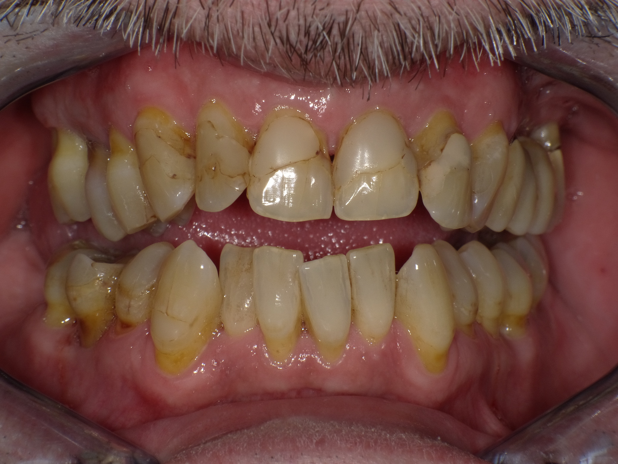 Unbefriedigende Ästhetik, vor allem aber Entzündungen im Knochen und eine massive Parodontitis mit bereits gelockerten Zähnen