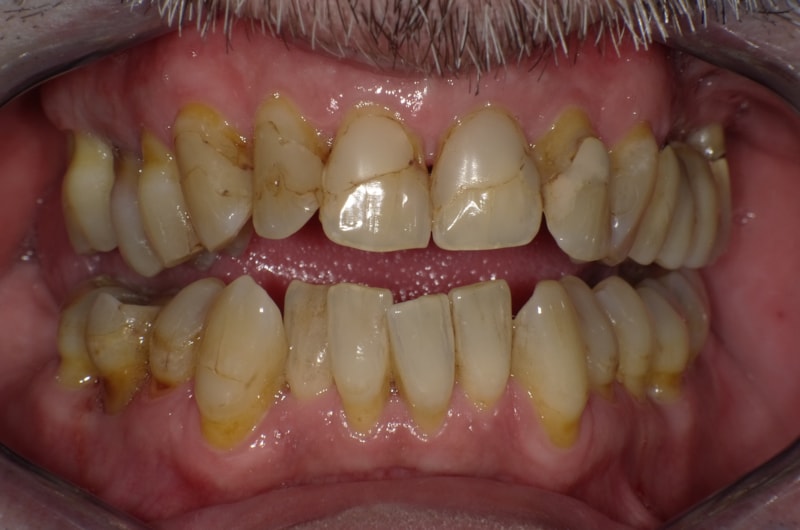 Unbefriedigende Ästhetik, vor allem aber Entzündungen im Knochen und eine massive Parodontitis mit bereits gelockerten Zähnen