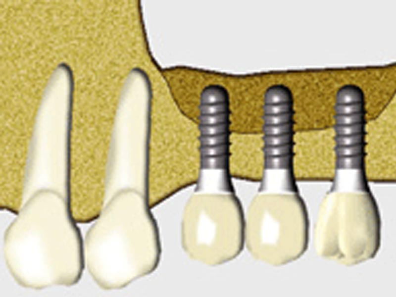 Zu wenig Knochen für Implantate? Die Lösung: Knochenaufbau mit Eigenknochen