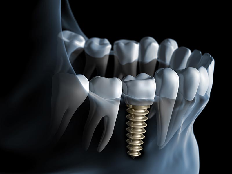 Konventioneller Zahnersatz oder Implantate
