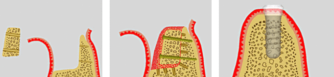 3D-Knochenaufbau mit Eigenknochen in Theorie 3D-Knochenaufbau mit Eigenknochen in Theorie